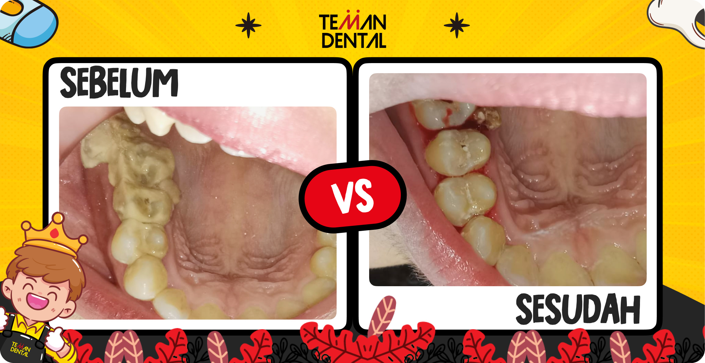 Foto testimoni Cleovita setelah scaling