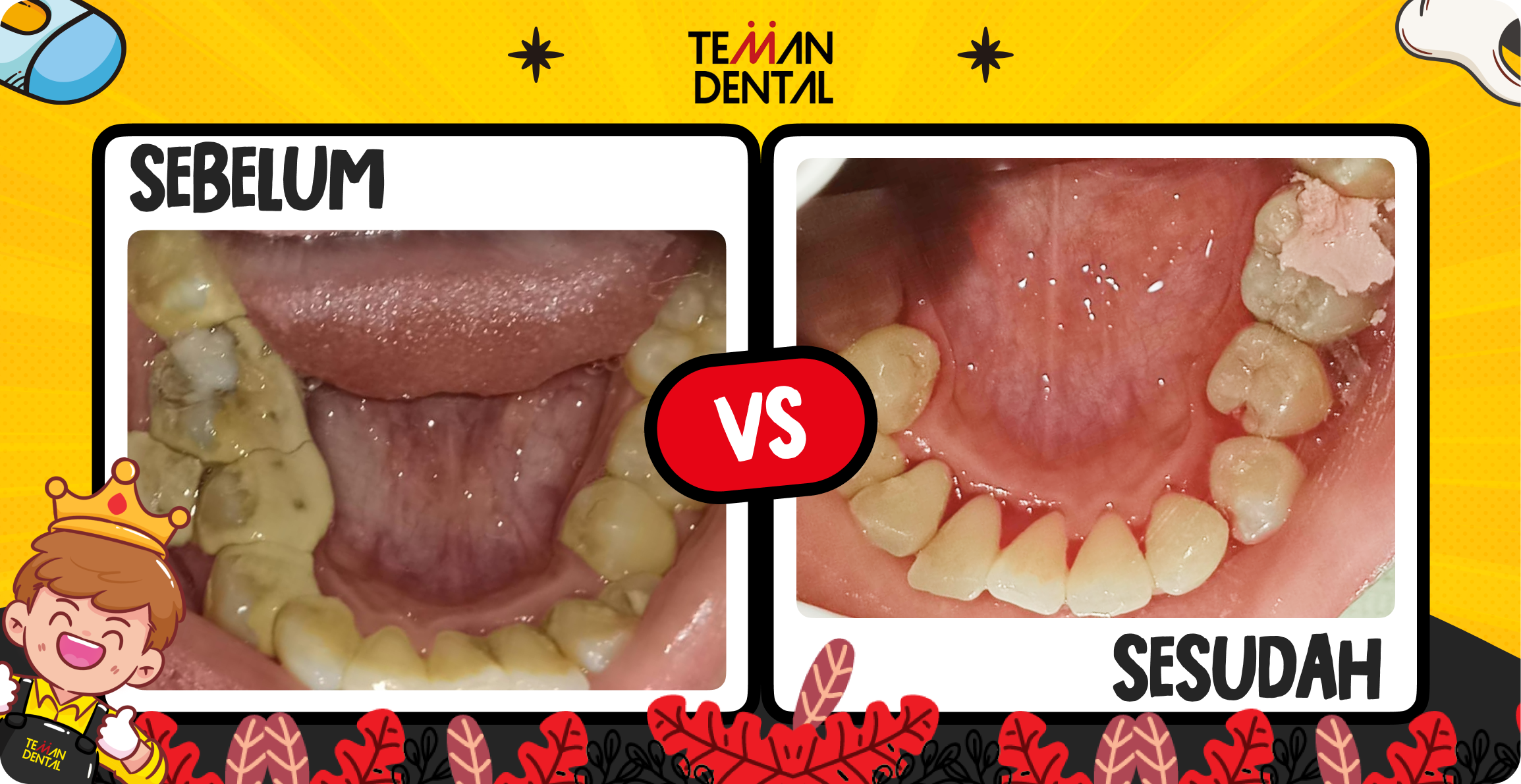 Foto testimoni Rifka Septiani setelah scaling